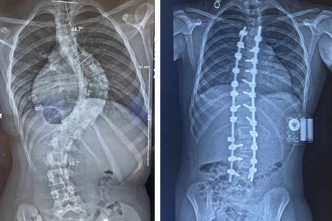 a side by side image of two x-rays showing the before and after results of a spine using a scoliosis brace