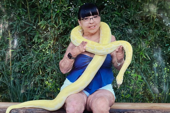 a child with burn scars holding a large snake