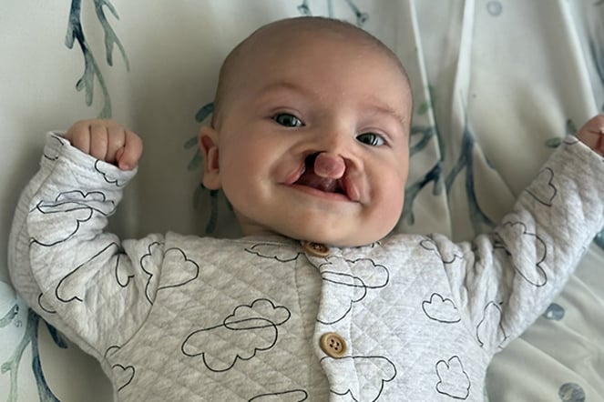 a smiling child with a cleft lip and palate