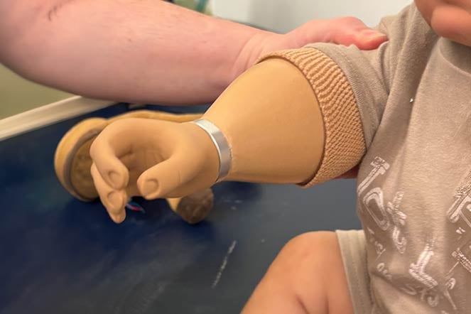 prosthetic arm closeup