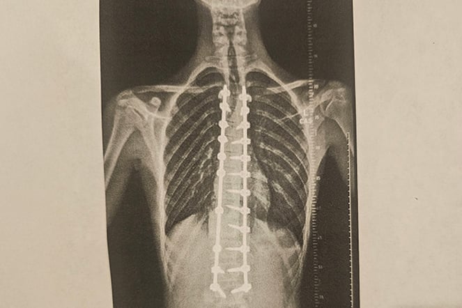 an X-ray of a spine after spine surgery