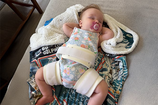 a sleeping child with a leg brace