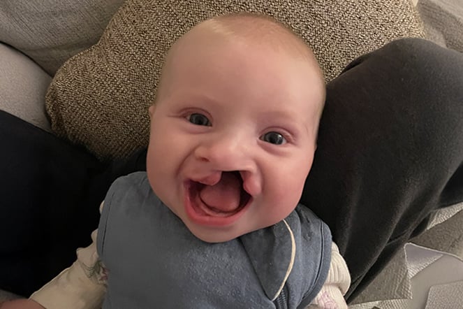 a smiling child with a cleft lip and palate