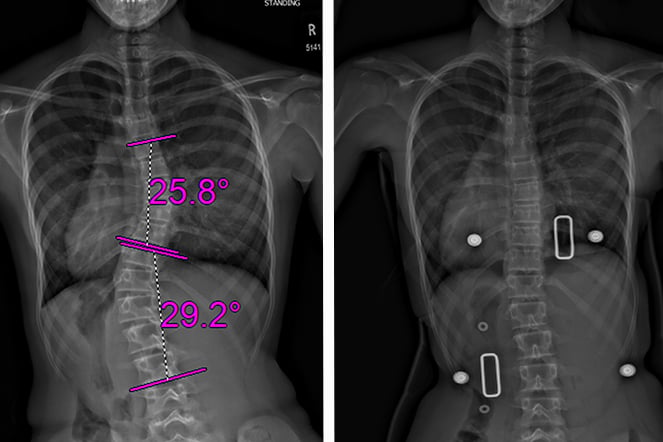 Side-by-side spinal X-rays showing scoliosis before and after treatment with a brace. The left image displays a curved spine with measurement overlays indicating spinal curvatures of 25.8° and 29.2°. The right image shows improved spinal alignment while wearing a corrective brace, with brace markers visible on the torso.