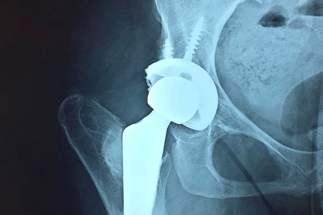 an X-ray of a hip replacement