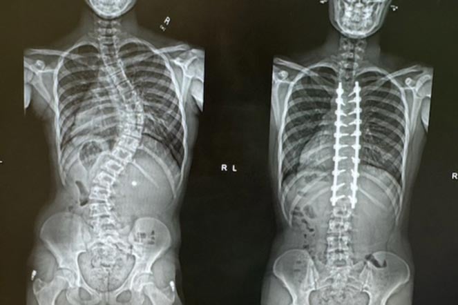 before and after scoliosis surgery X-rays of scoliosis patient spine