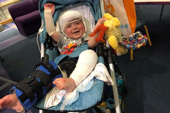 toddler burn patient in stroller with bandages and leg brace