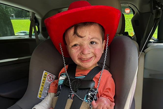 a child with visible burn scars wearing a red cowboy hat while sitting in a car seat