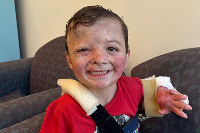 A young patient with visible burn scars sits in a large chair in hospital lobby.