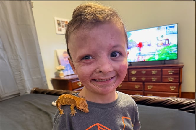 Close-up indoor portrait of a child with visible facial burn scars, smiling at the camera while a small orange crested gecko rests on one shoulder.