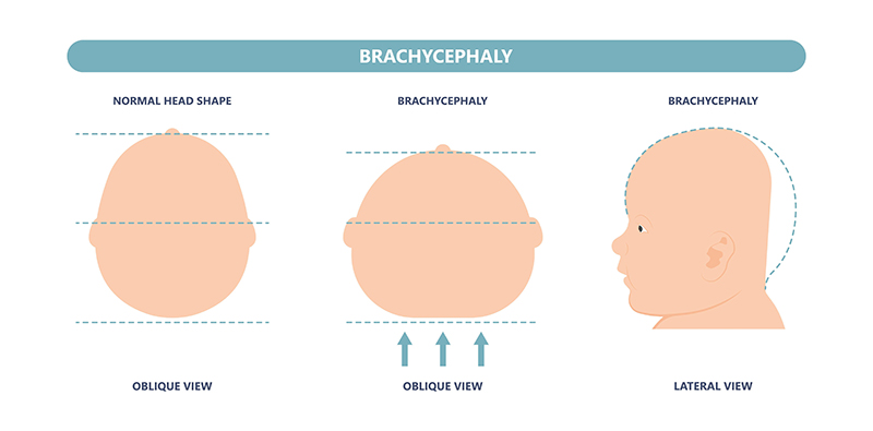 brachycephaly chart; oblique and lateral view