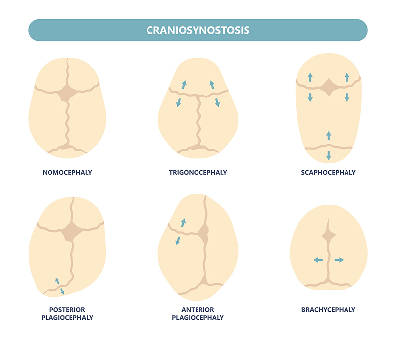 craniosynostosis chart showing nomocephaly, trigonocephaly, scaphocephaly, posterior plagiocephaly, anterior plagiocephaly, brachycephaly