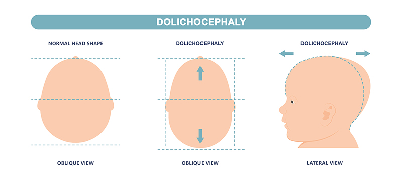 dolichocephaly chart; oblique and lateral view
