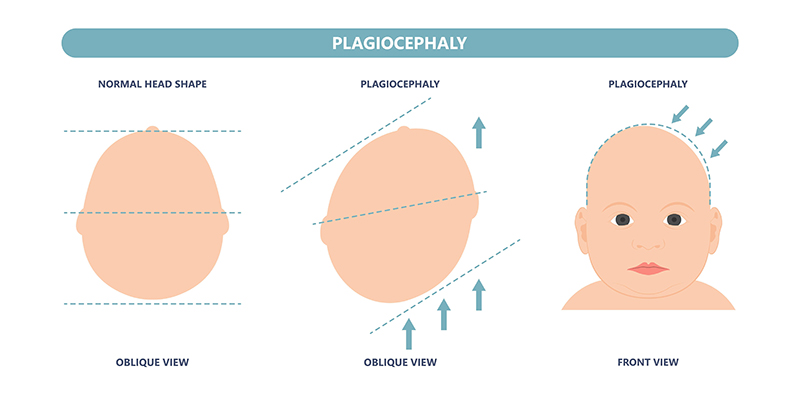 plagiocephaly chart; oblique and lateral view