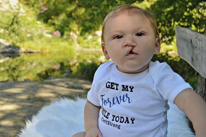 Baby Hunter, cleft lip patient