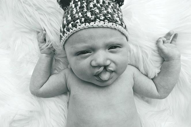 Baby Hunter, cleft lip patient