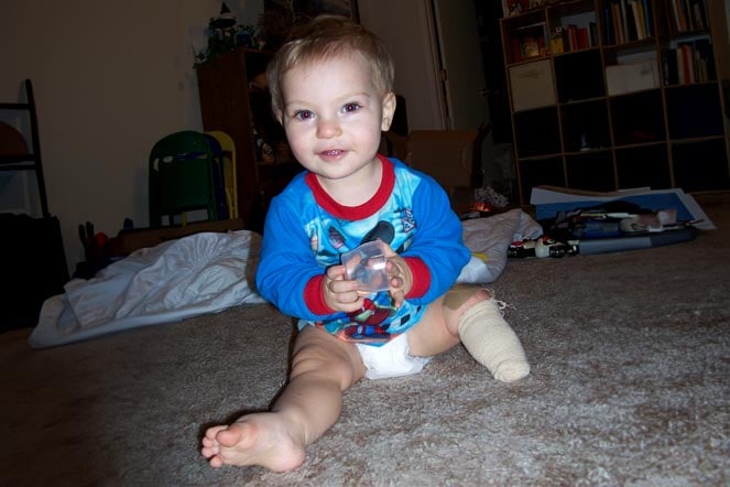 baby Colton, leg amputation visible