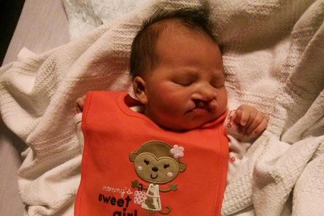Baby Mila with cleft lip