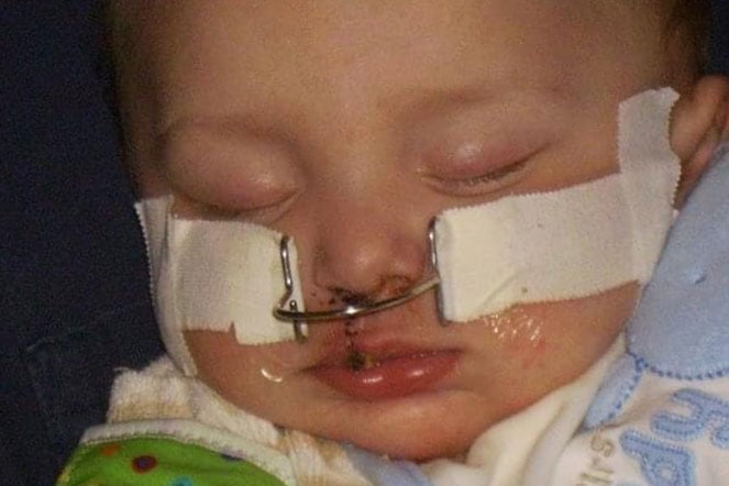 baby Zachary after craniofacial surgery