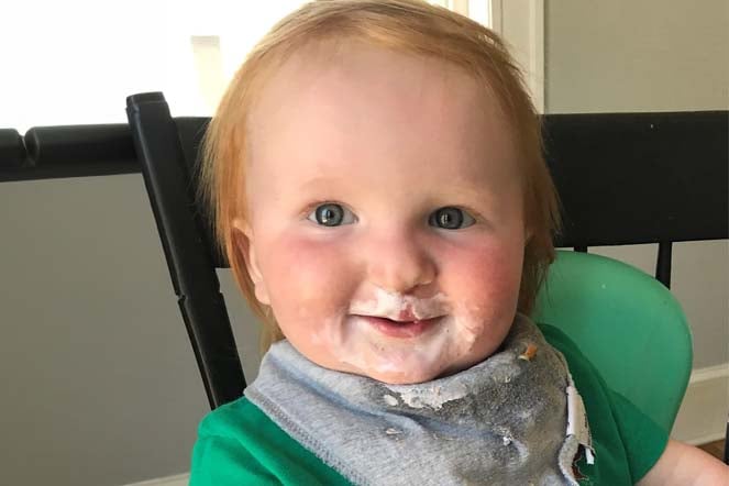 craniofacial patient Beau as a baby