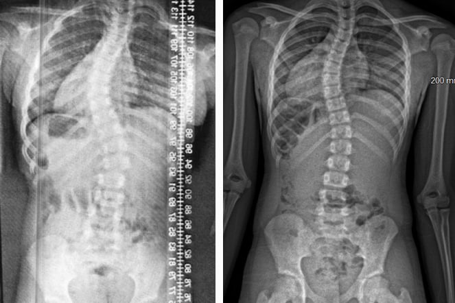 a before and after image of an x-ray featuring a spine