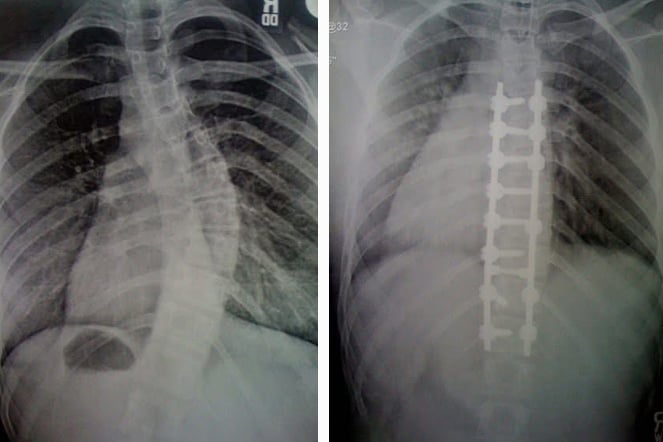 a before and after x-ray of a spine after spinal fusion surgery