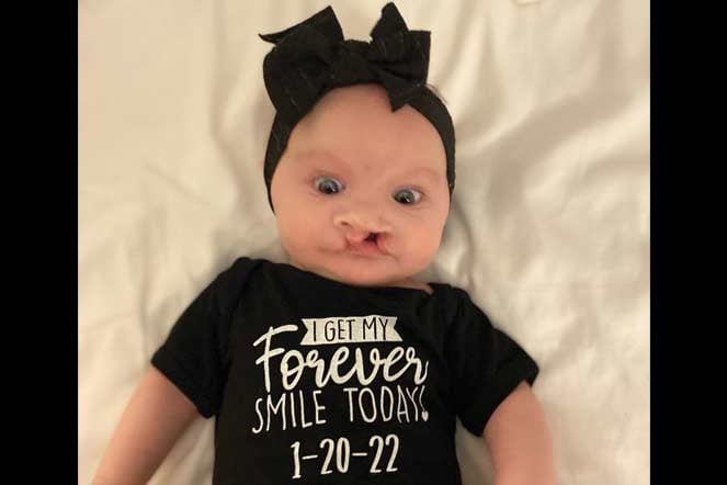 Charlie Gail pre-surgery wearing a onesie that says I Get My Forever Smile Today