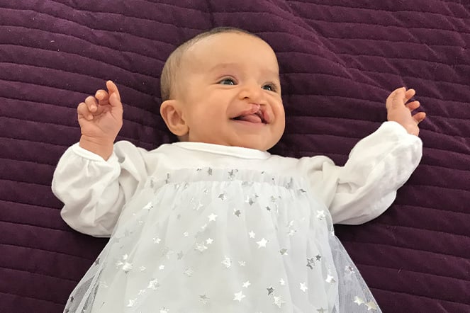 a smiling infant with a cleft lip and palate