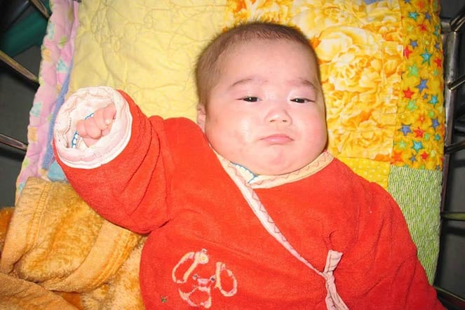 cerebral palsy patient Erica when she was a baby
