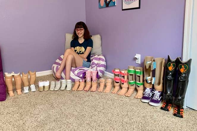 Grace with large prosthetic collection
