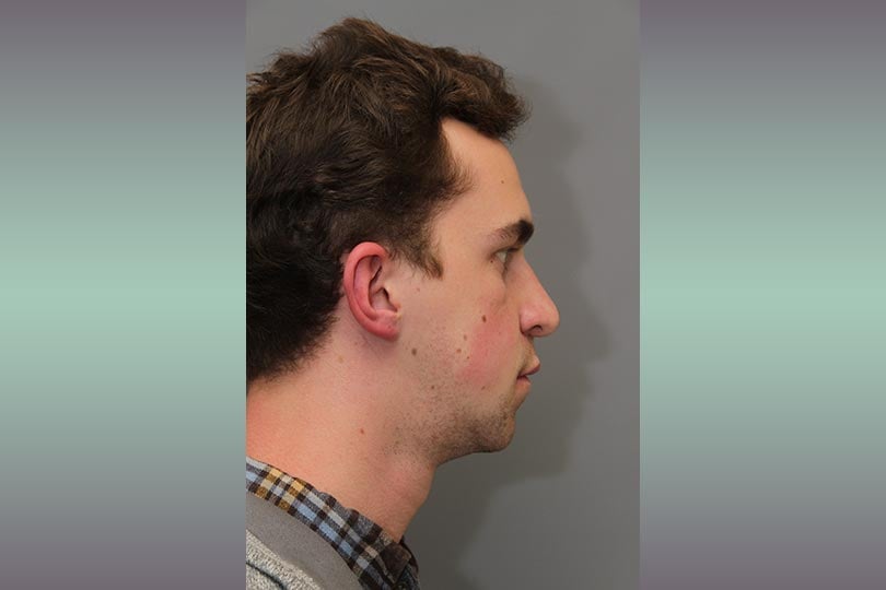 Graham after surgery