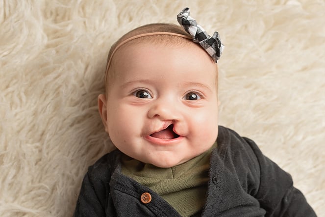 a smiling infant with a cleft lip and palate