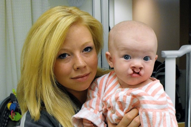 a woman holding a baby with a cleft lip and palate
