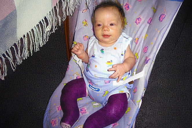 a vintage photo of an infant wearing leg casts