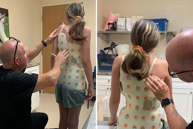 female scoliosis patient during brace fitting