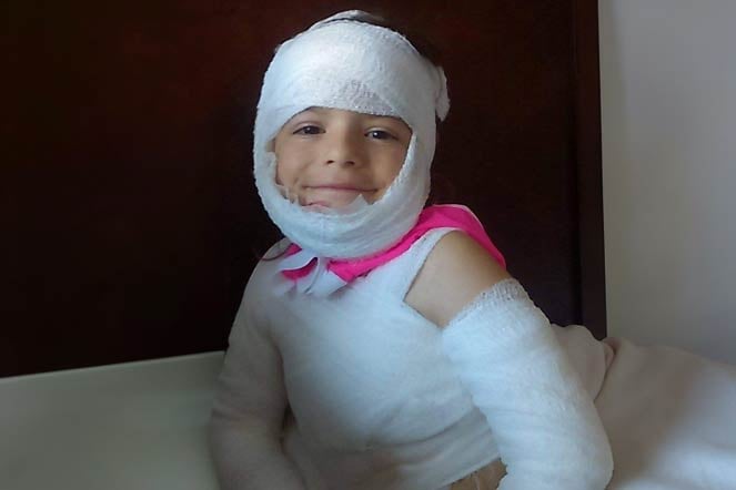 burn patient Nevaeh wearing bandages