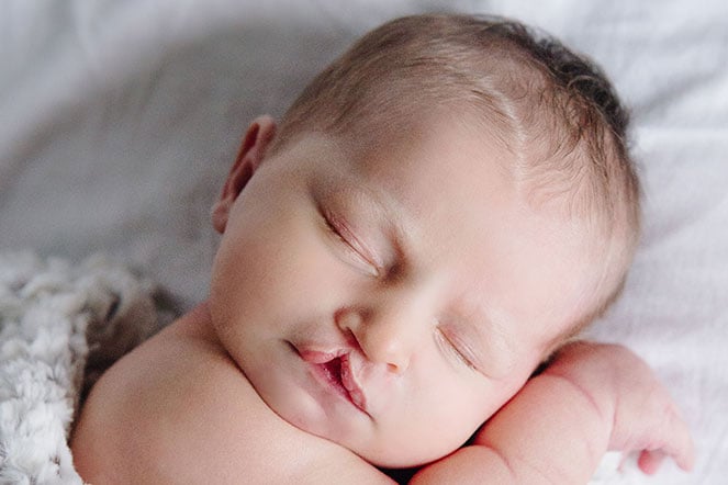 Penny as an infant, before cleft surgery