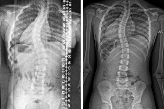 a before and after x-ray of a spine