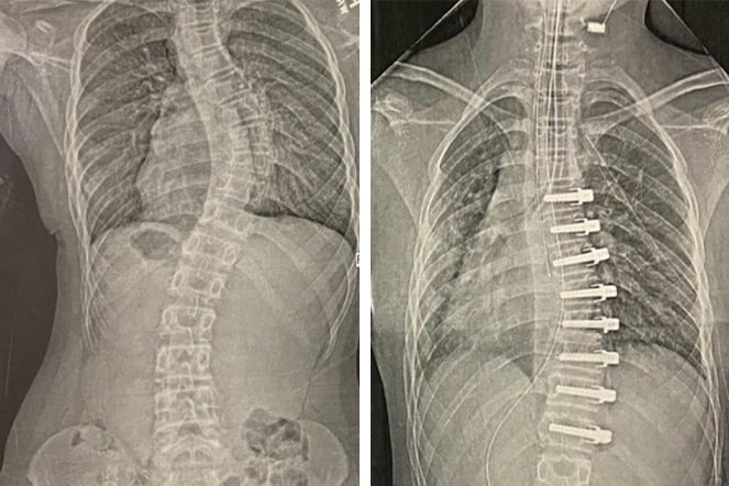 a before and after x-ray of a spine