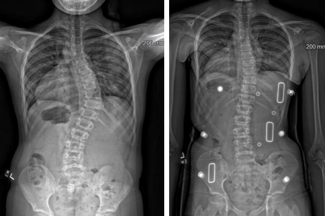 a before and after x-ray of a spine