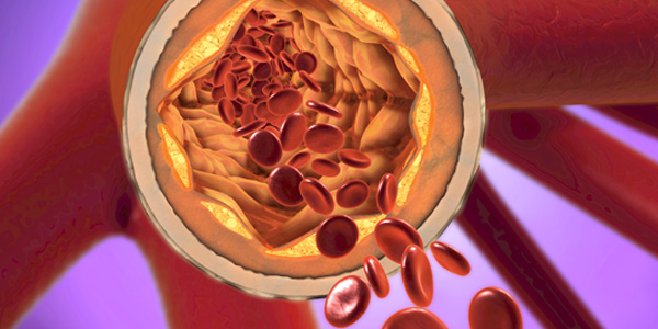 Graphic of effects of cholesterol on an artery