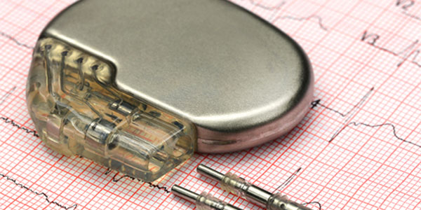 Pacemake and leads on electrocardiograph feed
