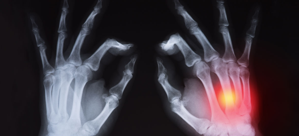 X-ray of hands