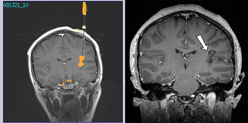 A patient who was suffering from seizures, underwent a LITT procedure. These MRI scans are before and after scans showing how much of the mass was destroyed.
