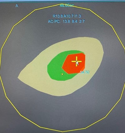 A heatmap image from a focused ultrasound.