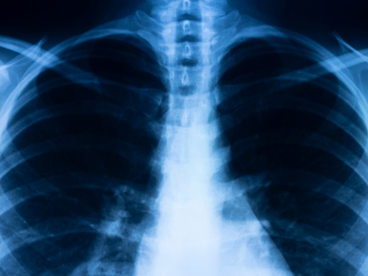 Chest scan
