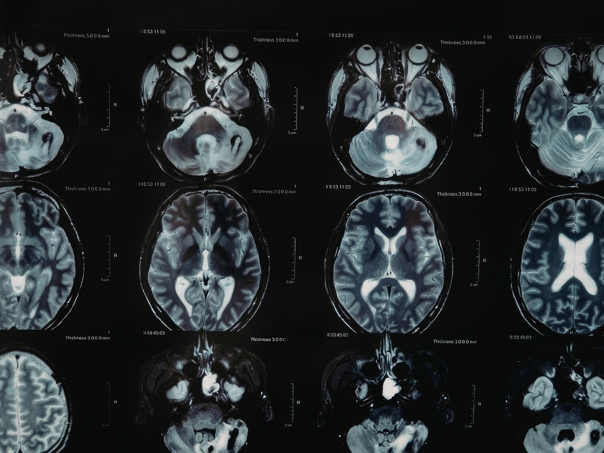 Brain scan