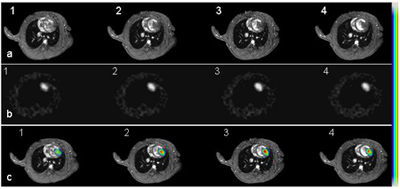 Short axis cardiac MR images of an infarcted heart 14 days after receiving 5M double-labeled ESCs