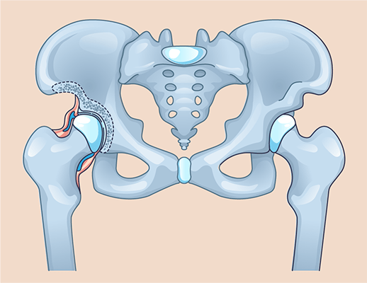 An illustration depicting hip dysplasia. The hip joint on the right side of the image has a shallow socket requiring PAO surgery