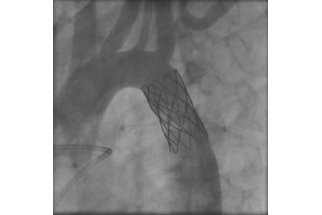 Coarctation Post-stent repair